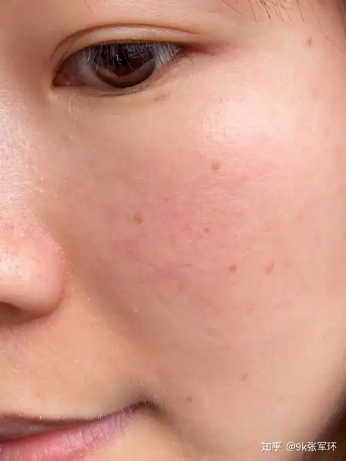 角质层薄皮肤屏障受损怎么修复