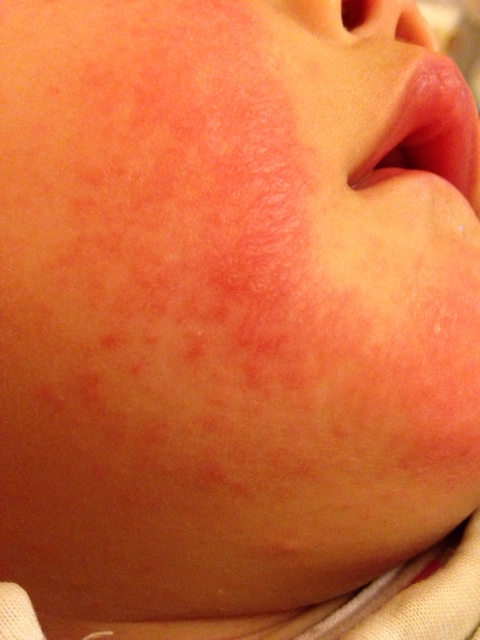 宝宝脸上发红是什么情况?