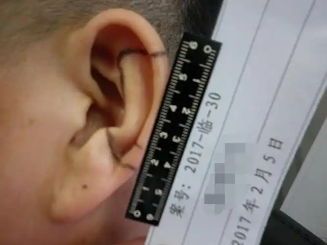 涞水司法医学鉴定中心对耳廓缺损伤残等级的法医临床鉴定