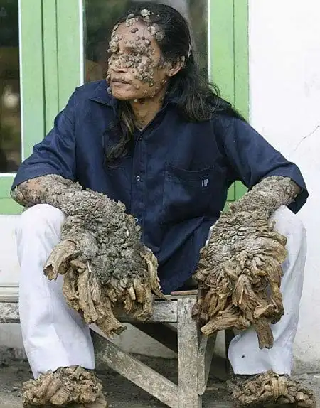 皮肤病之—树人