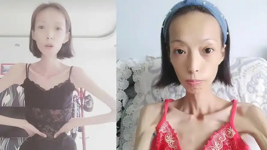 女子因病暴瘦58斤形如骨架,如今梦想吃胖成奢望