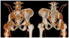 切掉多半骨盆身体掏个大窟窿居然还能到处溜达