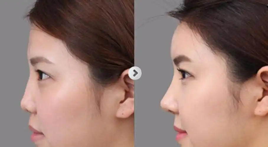 鼻部整形成功案例