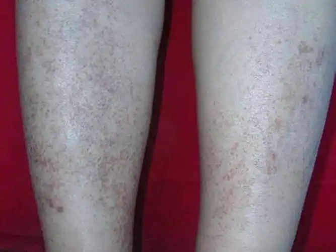 紫癜皮肤病的种类图片_有来医生