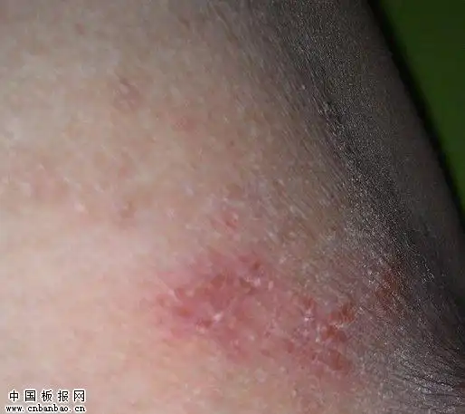 大腿肚内侧股癣图片大全