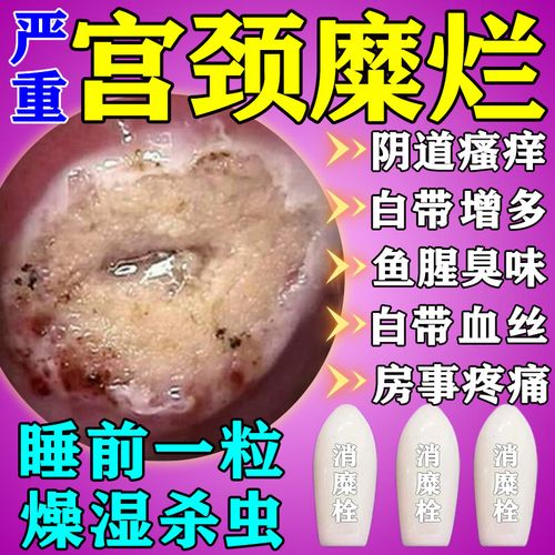 宫颈糜烂妇科用药二度三度消糜栓宫颈糜烂特专用效药妇科专用消炎药