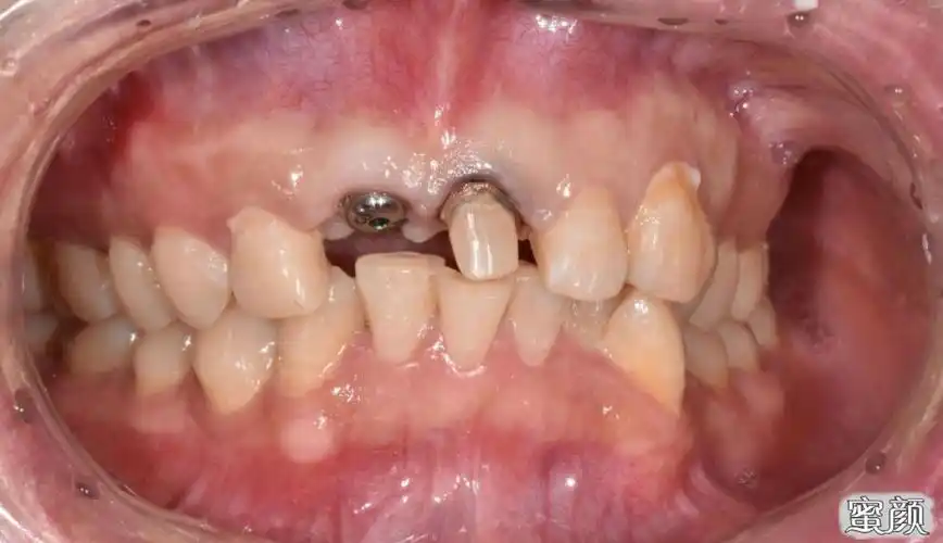 口腔种植牙全过程揭秘