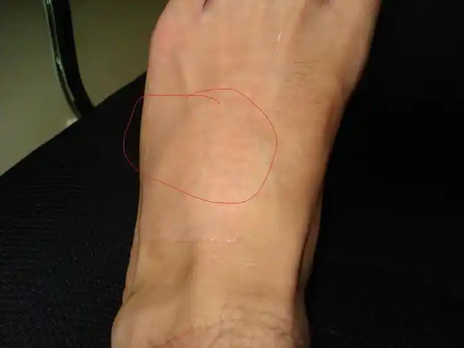 时间,主要症状等):前两个星期一次打球的时候脚折了,整个脚掌翻过去