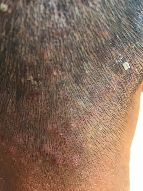 头皮起了一片红疙瘩,还有的有白泡,这是什么病!反复起,很痒!