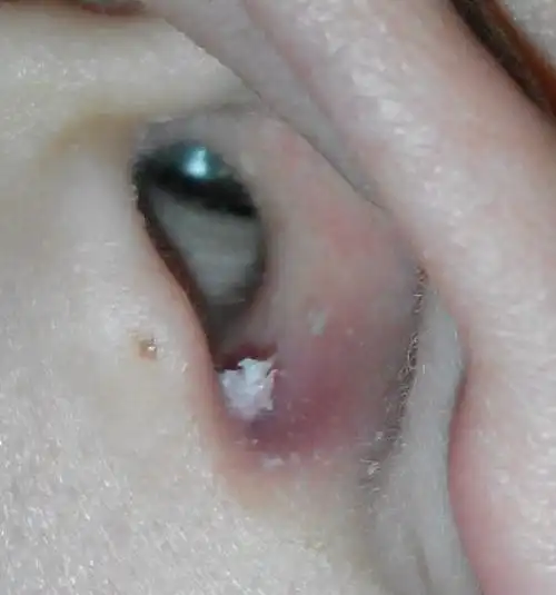 耳道里有个小疙瘩,长出尖尖的,有点硬,什么东西 ?如何治疗?