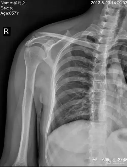 x片示右肩关节冈上肌附着点见多发结节状高密度影,ct扫描示钙化灶,ct