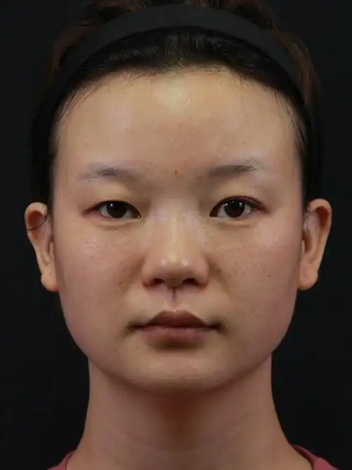 侧面来看,山根高度不够,鼻头圆钝,鼻翼略微肥厚,秀_圈子-新氧美容整形