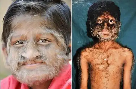 世界十大最恶心皮肤病皮肤蝇蛆病就是莲蓬乳图