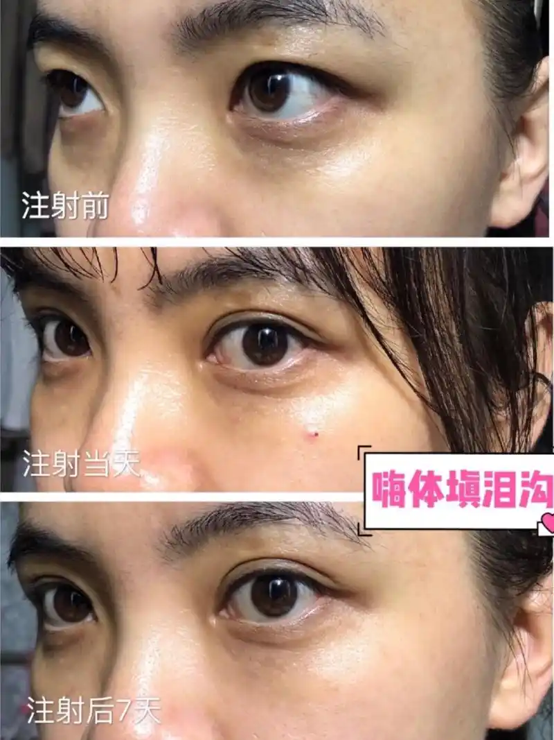 嗨体填充泪沟和眼窝的效果如何呢?