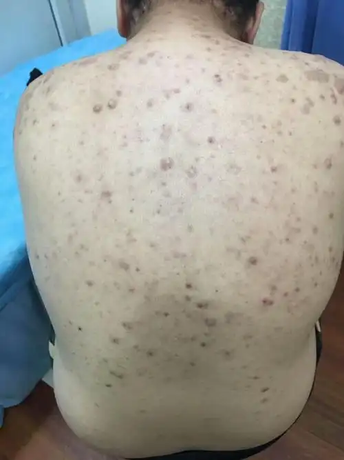 你知道毛囊炎的危害吗