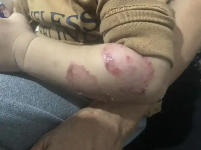 小孩2岁 皮肤一块一块的烂 !