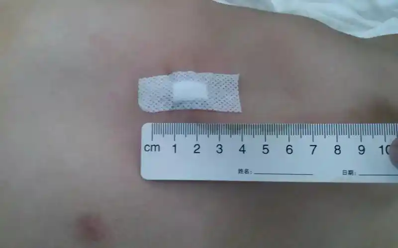 新鲜事五岁男孩胸部凹陷可以装水养小金鱼