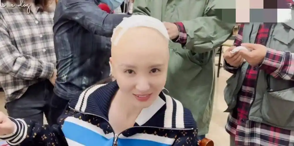 40岁张萌挑战光头造型!穿奢侈针织衫颜值耐打,头贴纱布惹人心疼_工作