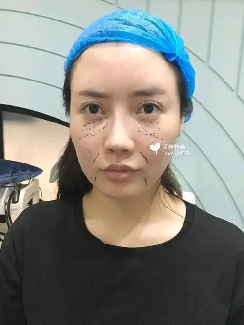 线雕| 面部线雕| 这是一个变美的魔法