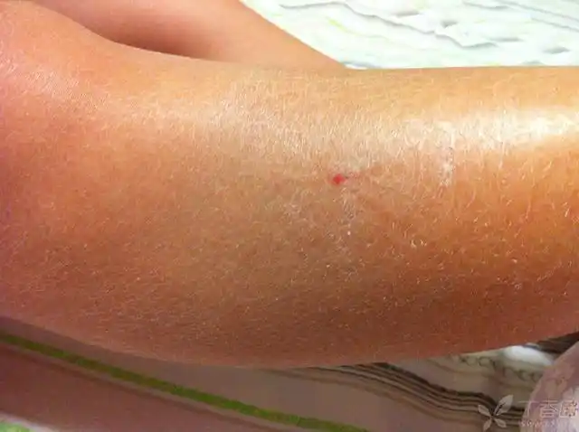 【请教】皮肤角质化 [病例帖]