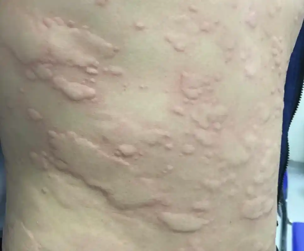 身上突然起了很多红色风团疙瘩,越挠疙瘩越多,看起来十分吓人  一般