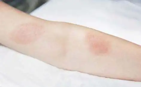 艾滋病初期小红点照片什么样子的(附图片)