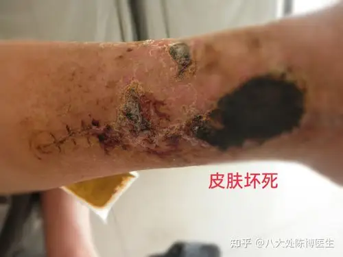 吸脂存在的风险