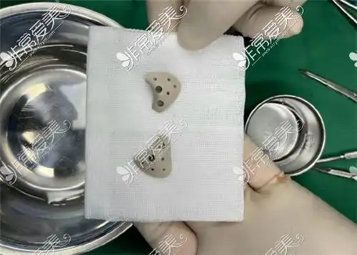 联合丽格张金辉鼻子做得好吗3d打印peek技术鼻修复填充厉害