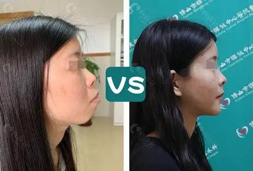 多组朴正国凸嘴矫正对比照看技术咋样不愧是有名正颌医生