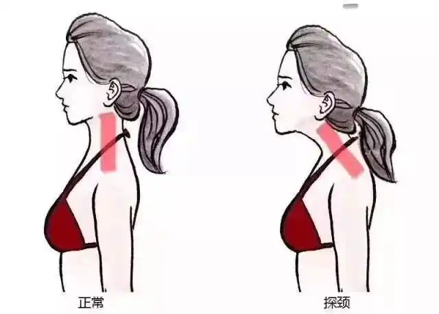 "头前引"影响的不只是美,还有其他危害!如何正确的训练改善?