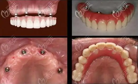 70岁老人在北京瑞泰口腔丰台医院用4颗种植体解决了半口牙缺失