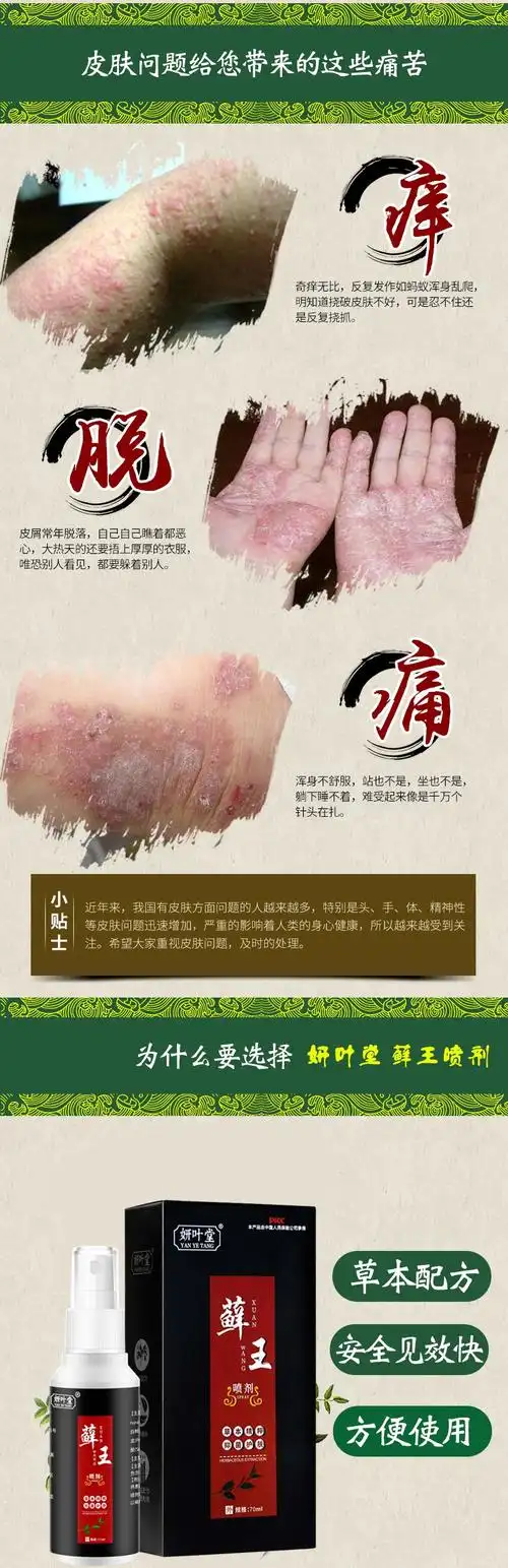 头癣头部牛皮肤癣脂溢性皮炎头皮藓银屑癣止痒膏煤焦油洗发水液硫磺