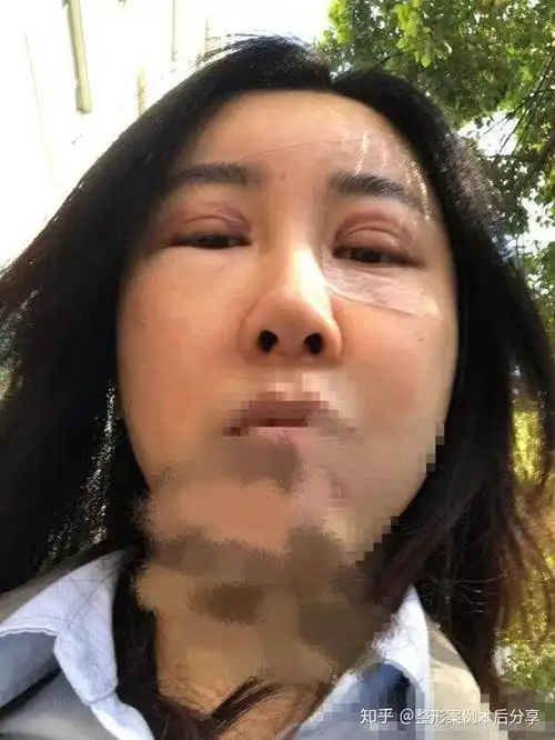 做双眼皮 脂肪填充1年多了,右边眼袋脂肪还是肿胀着,眼窝凹陷,眼皮