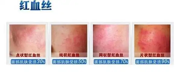 脸上有红血丝怎么办红血丝的修复护理和日常保养