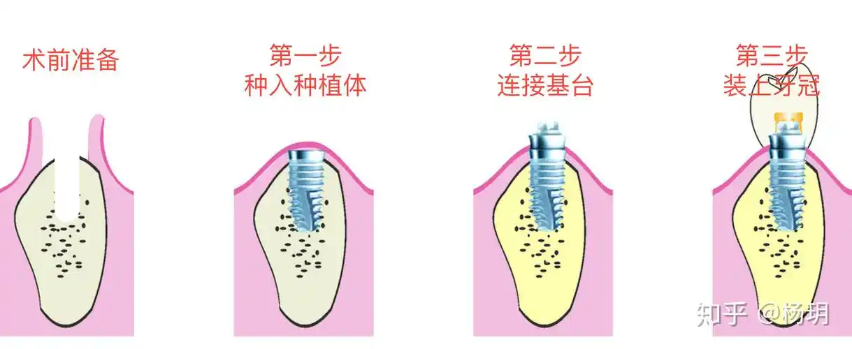 770做种植牙看这一篇就够了
