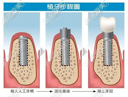 种植牙装完基台下面步骤?等等,一起来看看吧.