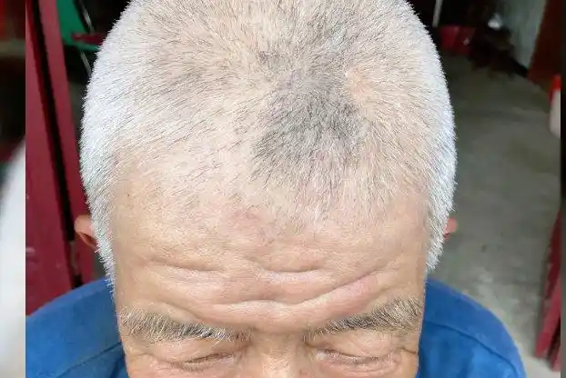 老年性白发病