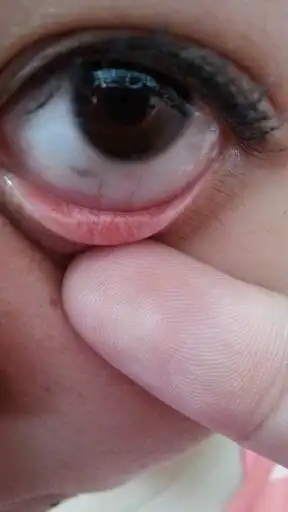 下眼睑膜里面长了一个硬物