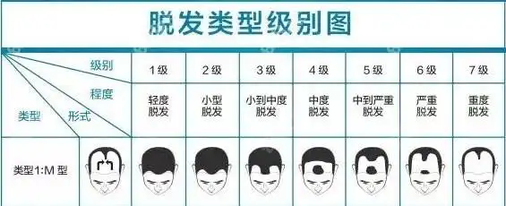 m型脱发大概需要种植多少毛囊呢如果不植发一定会秃吗