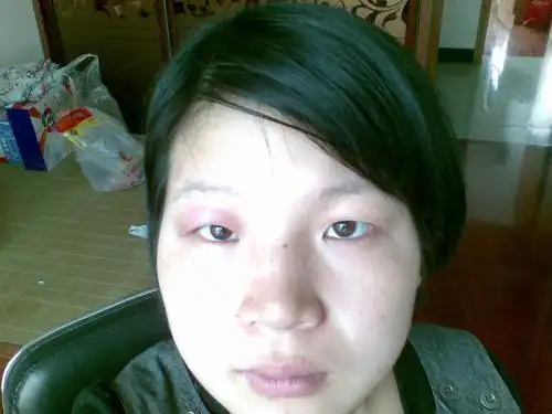 我的右眼皮红肿是什么原因?