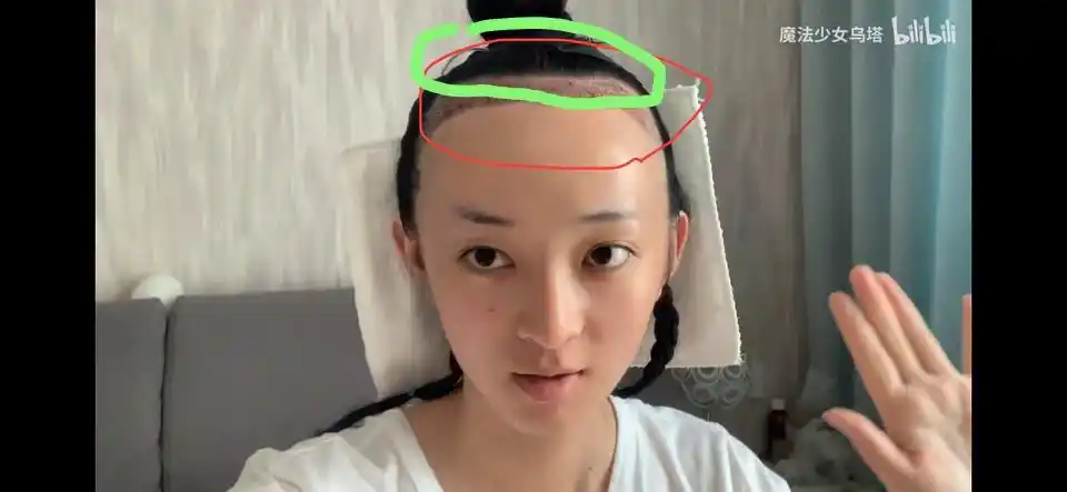 真相探讨|华晨宇"被"植发开扒