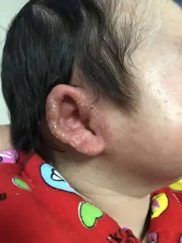 宝宝耳朵红肿,流黄的水怎么回事?