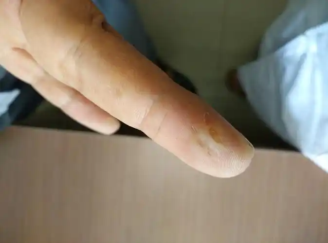 反复发作持续生长的双足底皮肤大面积角质化