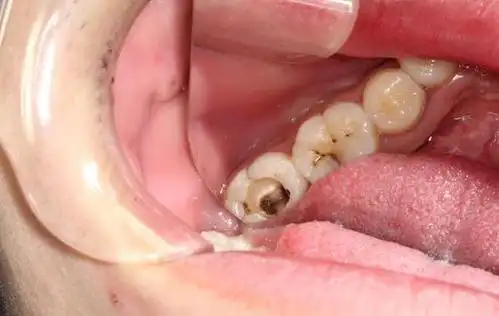 右下第二磨牙根管治疗