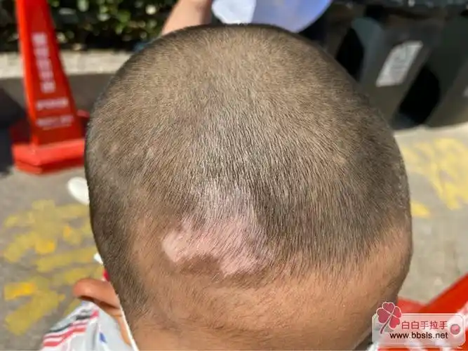 儿童治疗版-白白手拉手-手拉手白癜风论坛-白癜风患者的网上家园!