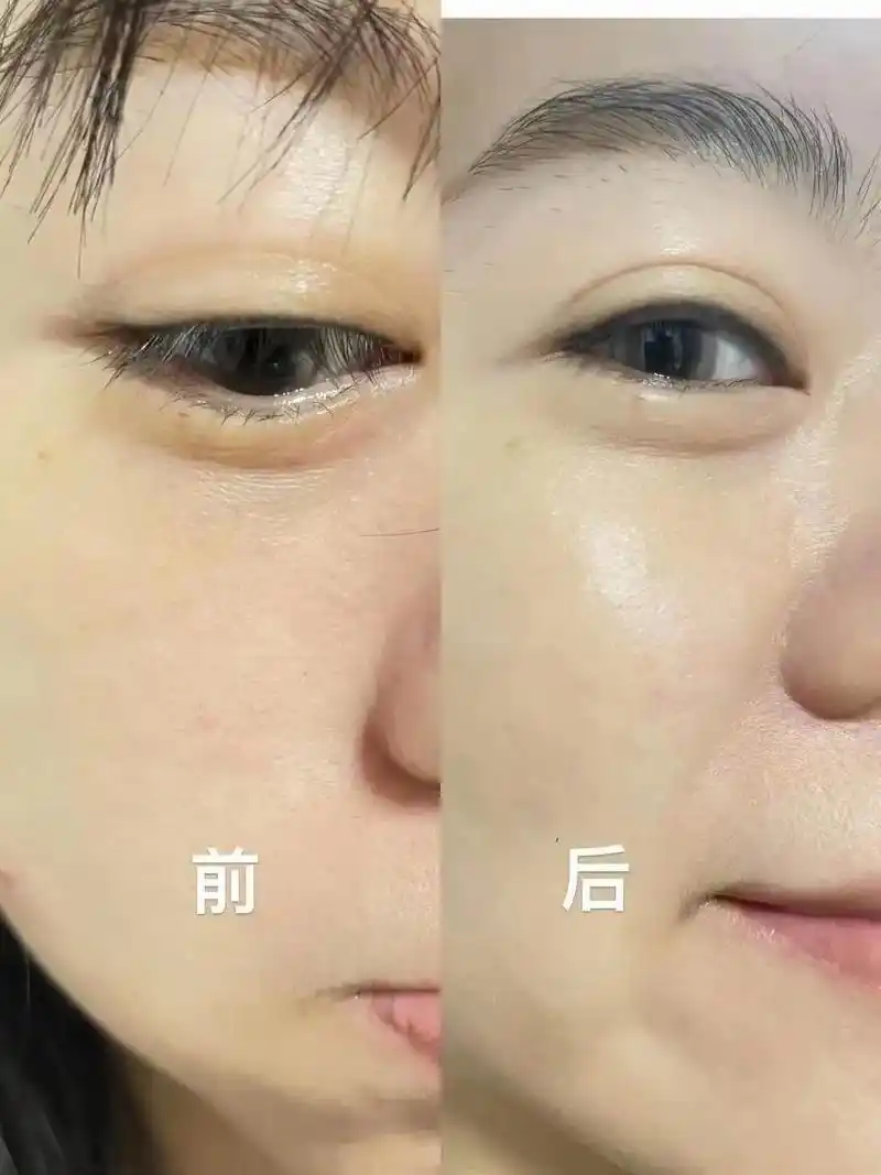 顾客之前皮肤粗糙,毛孔粗大无光泽,旁分泌干细胞操作一次效果, - 抖音
