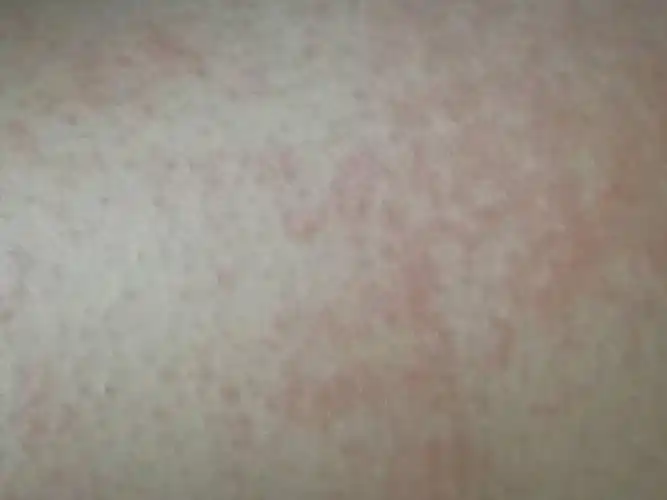 身体上突然张红疹子,这是怎么回事?这是什么疹子