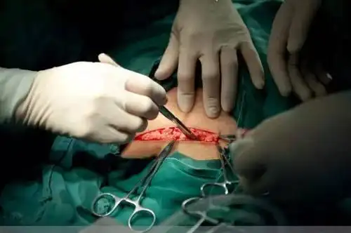 女人生孩子的姿势 一仰卧式方式产妇平躺在床上,两腿张开抬高,多采此