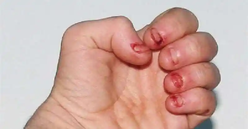 他一紧张总会啃咬指甲,不料这个看似没什麼的坏习惯竟然引发严重后果!