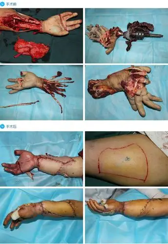 旋转撕脱离断伤行再植术